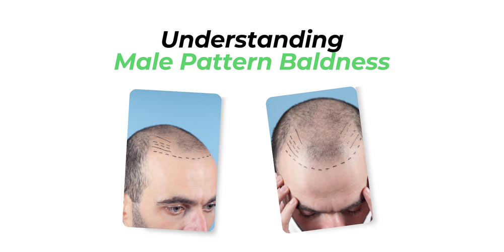 Understanding Male Pattern Baldness – Skull Shaver
